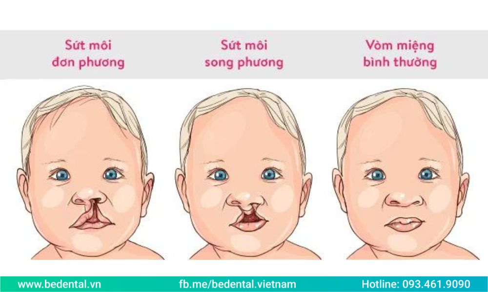 KHÁM VÀ PHẪU THUẬT CHO TRẺ KHE HỞ MÔI - VÒM MIỆNG
